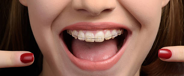 ceramic-braces-teeth-close-up-shot