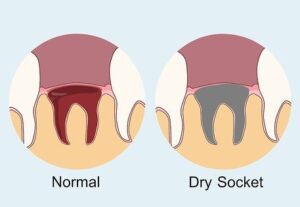 Read more about the article What is Dry Socket? How to Treat and Prevent Dry Socket
