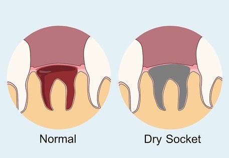 Dry-Socket-After-a-Tooth-Extraction