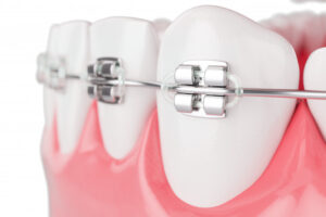 Read more about the article Lingual Braces Treatment in London