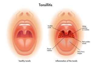 Read more about the article How to Get Rid of Tonsil Stones (Tonsilloliths)