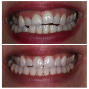 lingual-braces-before-after-treatment