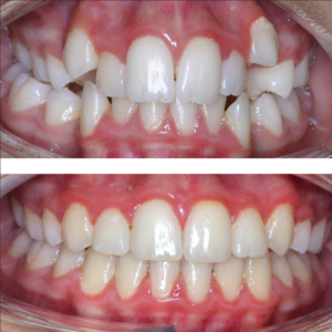 lingual-braces-before-and-after-transformation