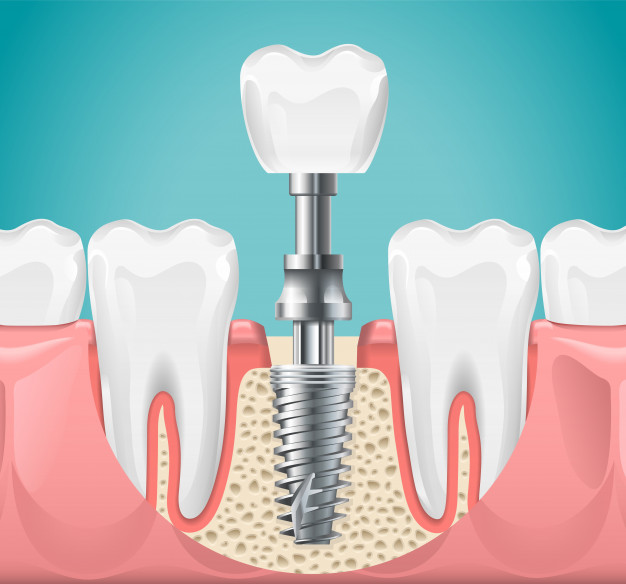 mini-dental-implant-cut-illustration