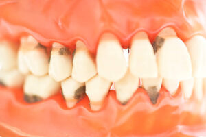 Read more about the article Rotten Teeth: Signs and Treatment