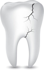 Read more about the article Understanding Cracked Tooth Treatment and Symptoms