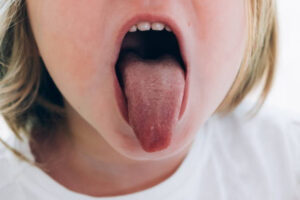 Read more about the article What is transient lingual papillitis?