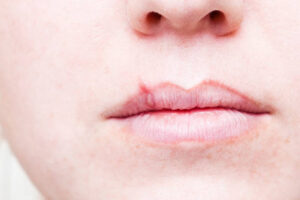Read more about the article How to get rid of a canker sore in 24 hours?
