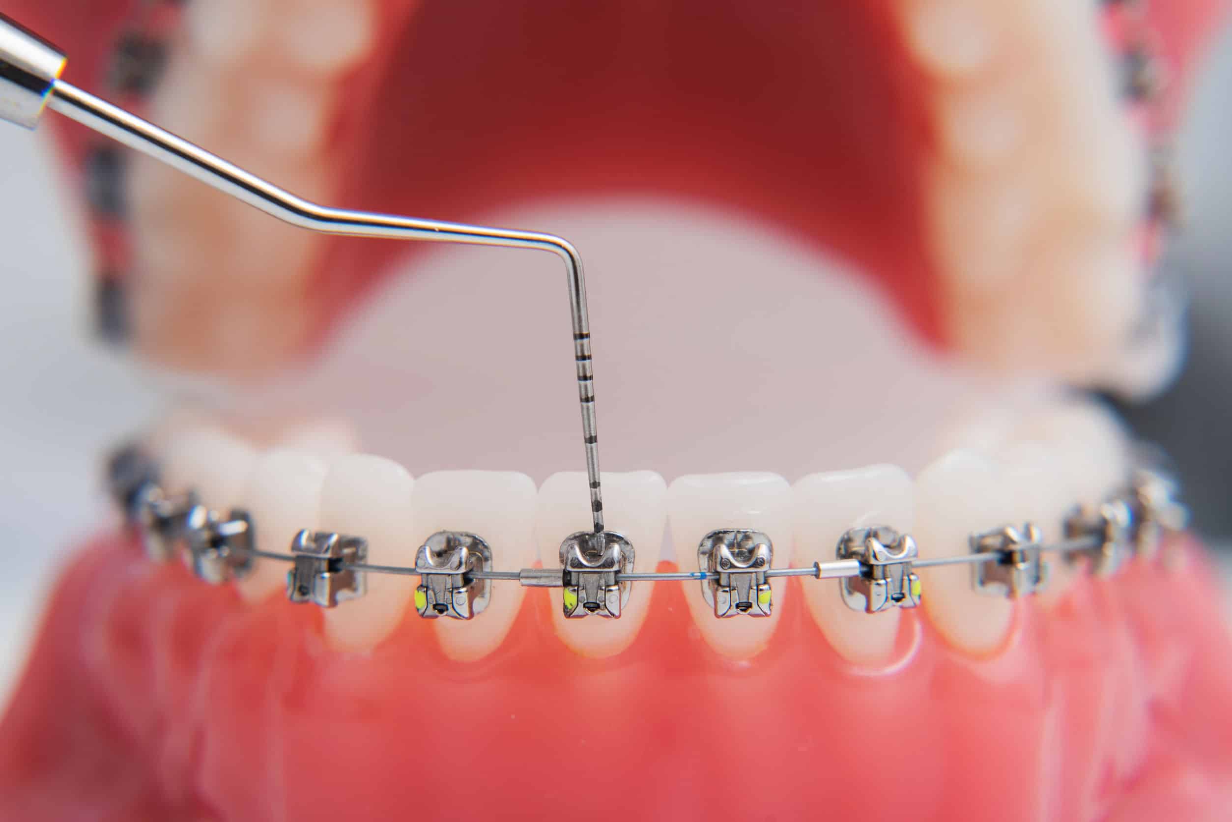 All About Elastics - Bronsky Orthodontics