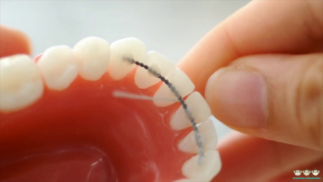 how-to-floss-with-a-permanent-retainer