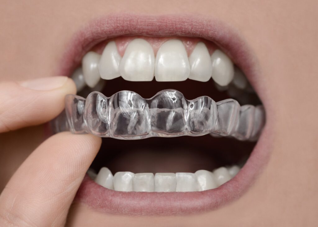 What are Replacement Retainers? Invisalign London
