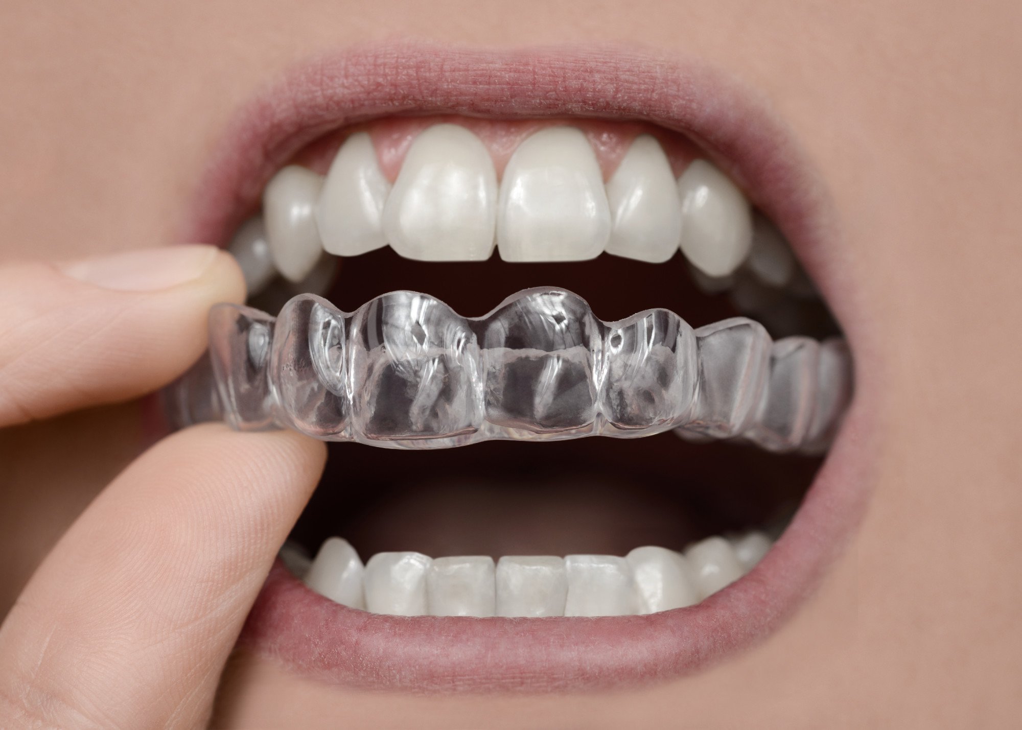 You are currently viewing What are Replacement Retainers?