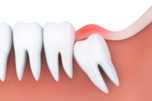 Read more about the article How Long Does it Take for Wisdom Teeth to Come In?