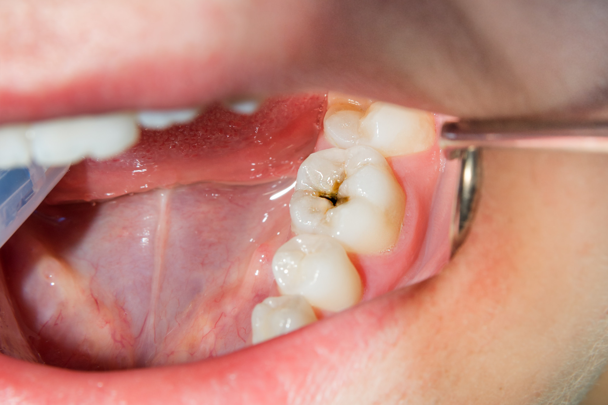 You are currently viewing What Does A Cavity Look Like? How To Tell If You Have Cavity?
