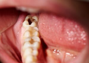 Read more about the article Dead Tooth – What To Do If You Have One?