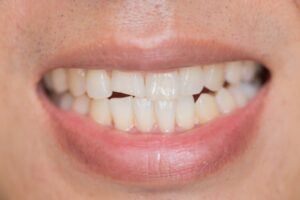Read more about the article How To Deal With A Chipped Or Broken Tooth?