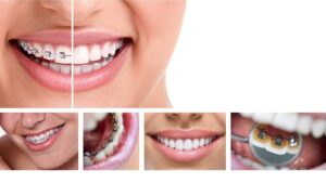 Read more about the article Lingual Braces Vs Invisalign