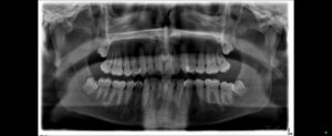 Read more about the article Mesiodens: A Complete Guidance to Cure Your Child