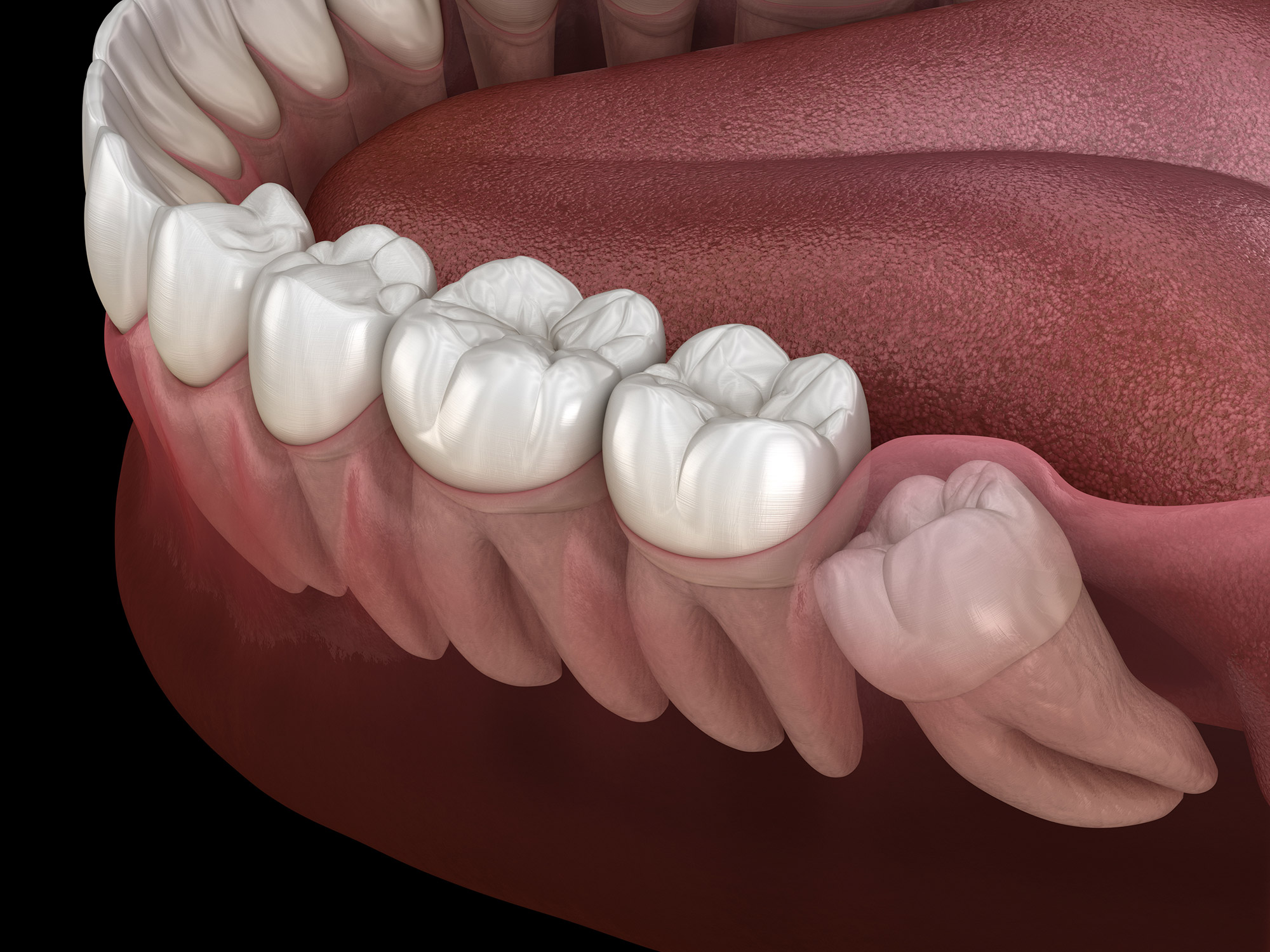 Read more about the article What Are Wisdom Teeth? What Are Wisdom Teeth Symptoms?