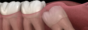 Read more about the article When Do Wisdom Tooth Stop Growing?